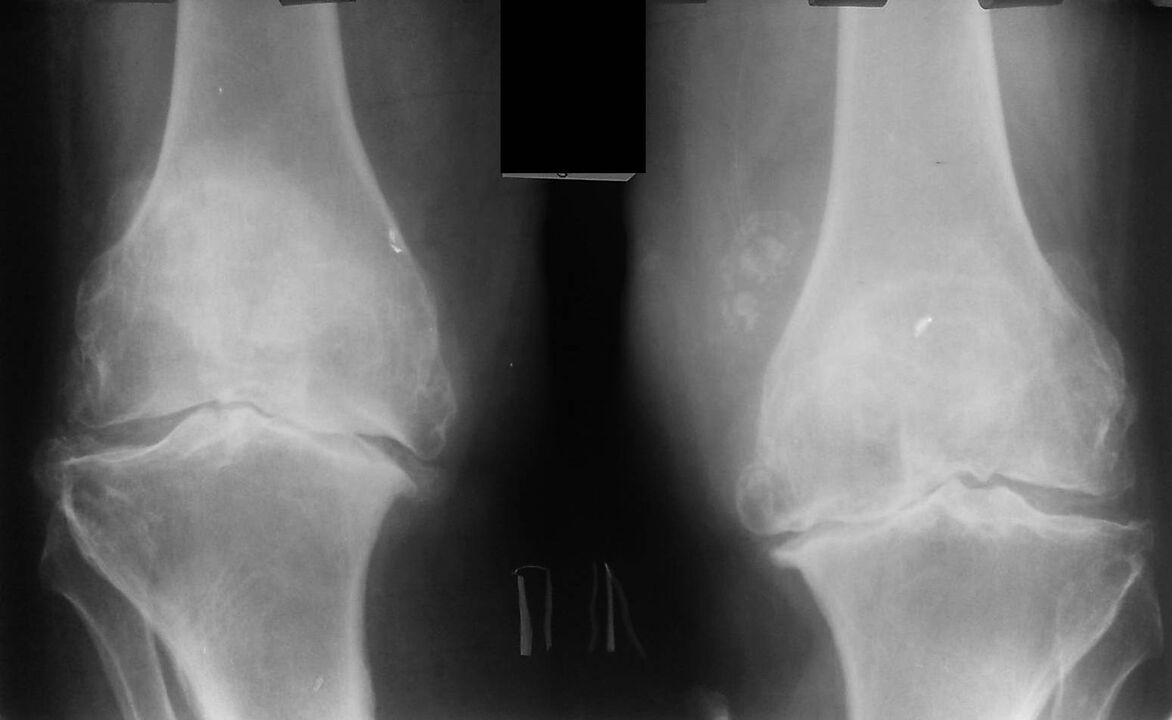 radiografia delle articolazioni del ginocchio con artrosi