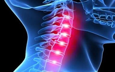 Sintomi di osteocondosi della colonna cervicale
