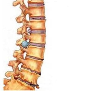 Come si sviluppa l'osteocondosi della regione cervicale