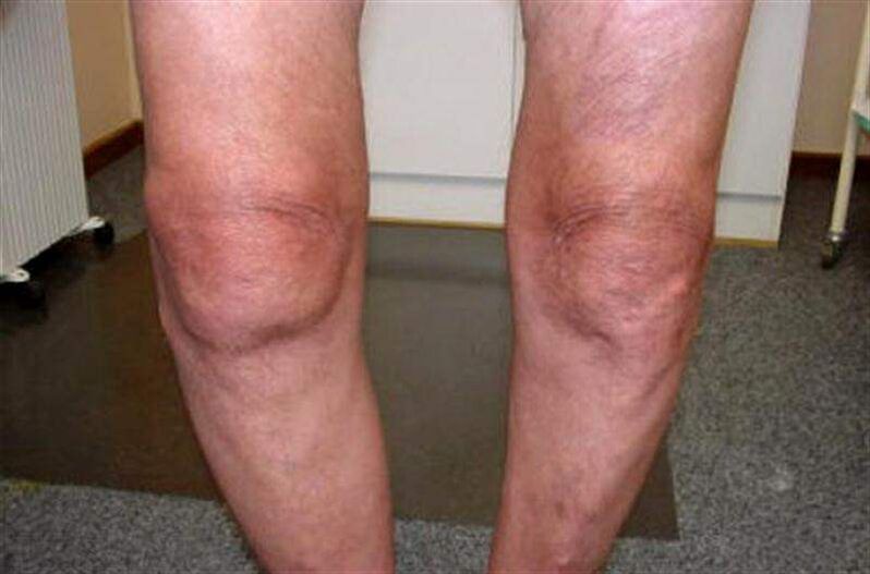 ginocchio gonfio a causa dell'artrite