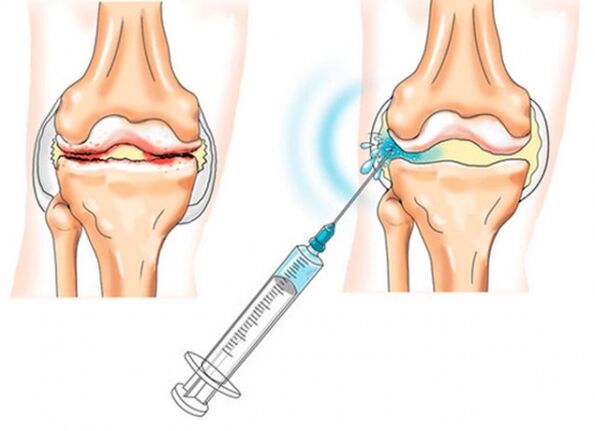 iniezioni intra-articolari per artrosi del ginocchio