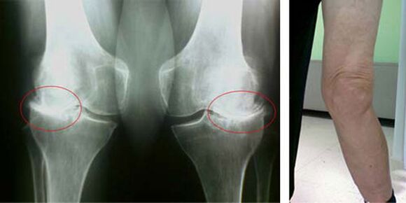 radiografia dell'artrosi del ginocchio