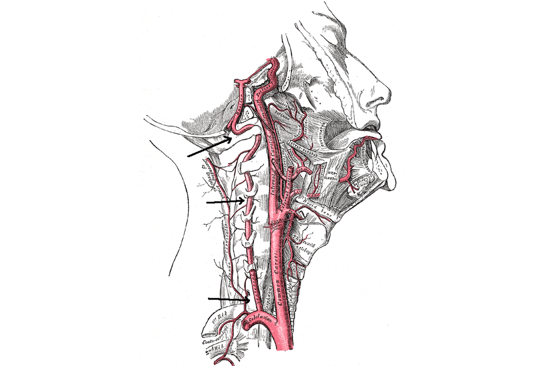 compressione dell'arteria vertebrale con osteocondrosi cervicale
