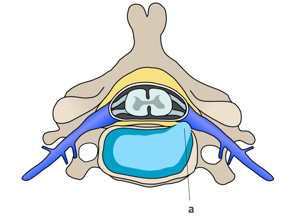 ernia intervertebrale con osteocondrosi cervicale