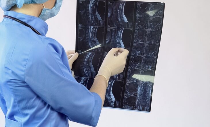 La diagnosi di osteocondrosi cervicale viene effettuata sulla base di uno studio MRI
