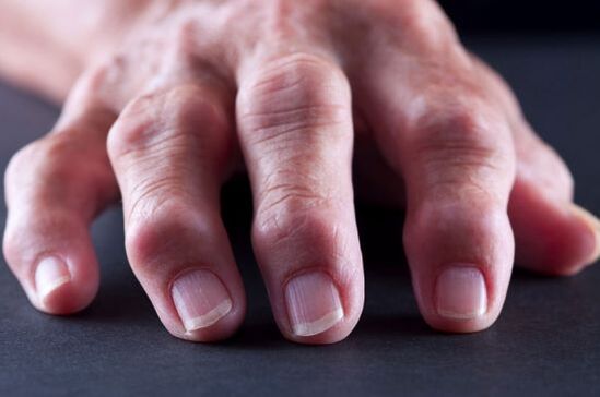 Deformità articolari delle dita dovute ad artrosi o artrite
